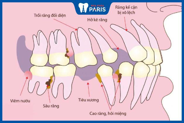 Một số tác hại của việc tiêu xương hàm răng