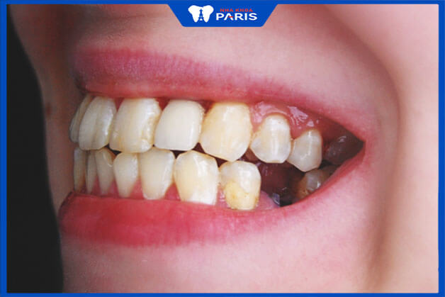 Giá trồng răng số 7 phụ thuộc nhiều vào tình trạng răng hiện tại