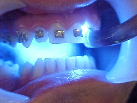 Trám răng Laser Tech có bền không