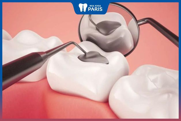 Trám composite là phương pháp chữa lung lay do răng sâu hiệu quả