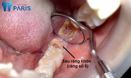 trẻ em bị sâu răng hàm có lỗ