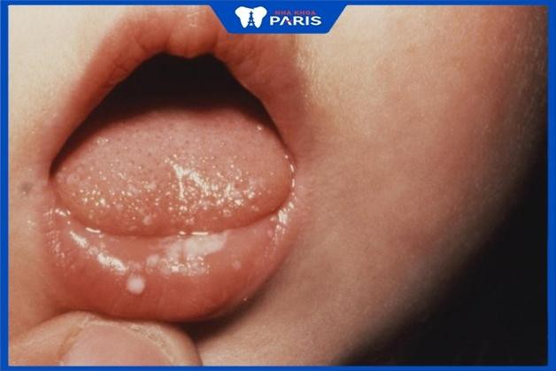 Trẻ sơ sinh bị nổi mụn nước ở miệng điều trị như thế nào?