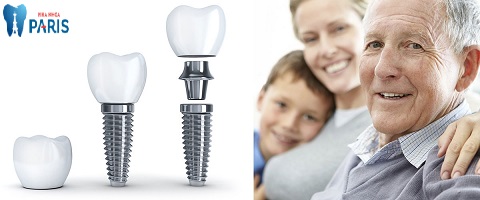 Trồng răng Implant cho người già - an toàn - hiệu quả - trọn đời