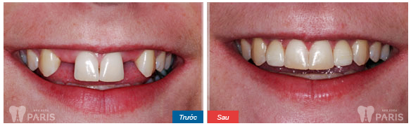 Phục hình răng cửa bằng phương pháp làm cầu răng sứ