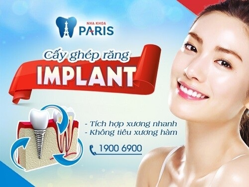 Công nghệ Implant 4S - Giải pháp phục hồi răng bền - chắc vĩnh viễn