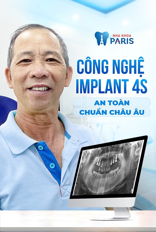 Công nghệ Implant 4S siêu an toàn