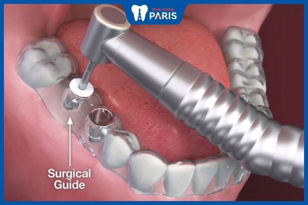 4S giúp trụ Implant bắt chặt vào hàm