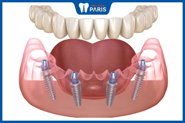 Giá trồng implant toàn hàm phụ thuộc vào lượng trụ, loại răng