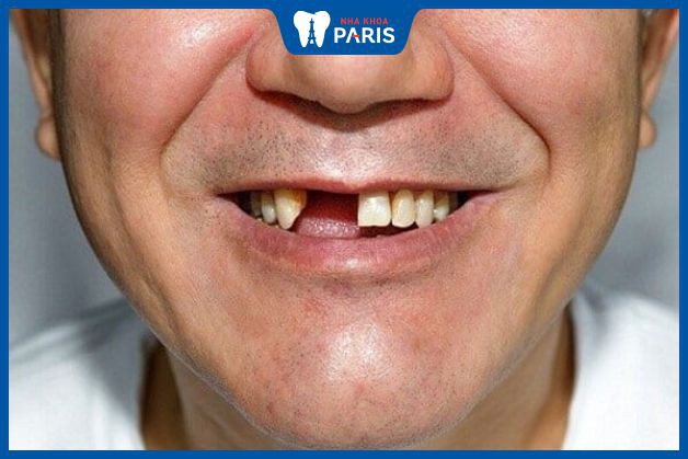 Người trưởng thành đủ điều kiện sức khỏe là có thể trồng răng implant