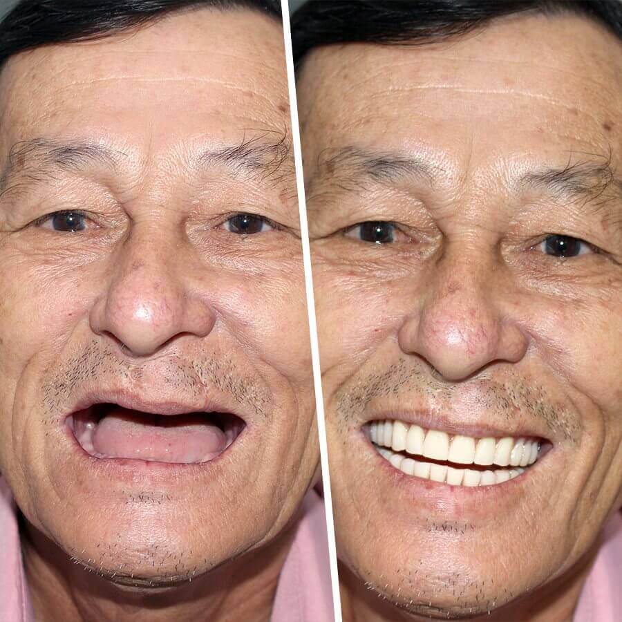 trồng răng giả cho người già