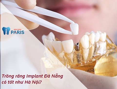 Trồng răng Implant tại Đà Nẵng có tốt như Hà Nội không?