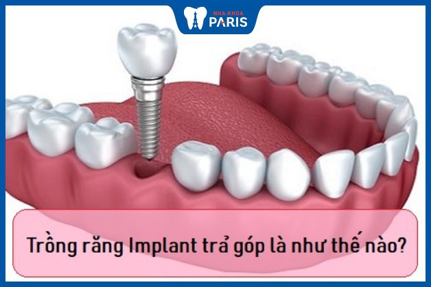 Trồng răng Implant trả góp là dịch vụ được khá nhiều khách hàng quan tâm, lựa chọn