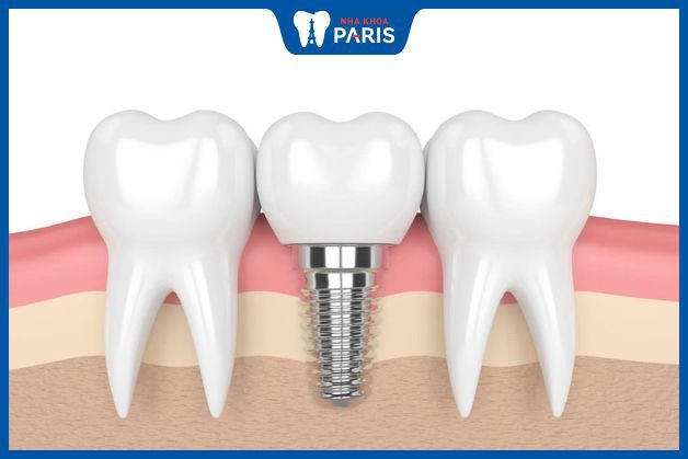 Implant là phương pháp trồng răng 7 tối ưu