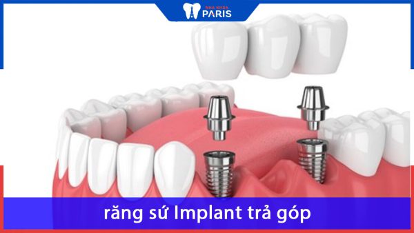 Trồng răng sứ Implant trả góp cần những điều kiện gì?