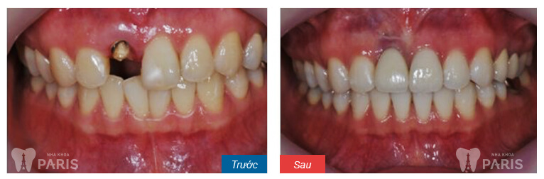 hình ảnh khách hàng trồng răng sứ thực tế 2
