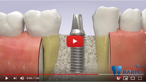 Để hiểu hơn về quy trình trồng răng Implant NHANH CHÓNG – AN TOÀN - HIỆU QUẢ tại Nha Khoa Paris, hãy xem ngay VIDEO dưới đây: