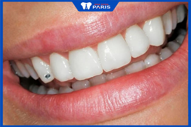 Các yếu tố làm ảnh hưởng đến thời gian đính đá lên răng