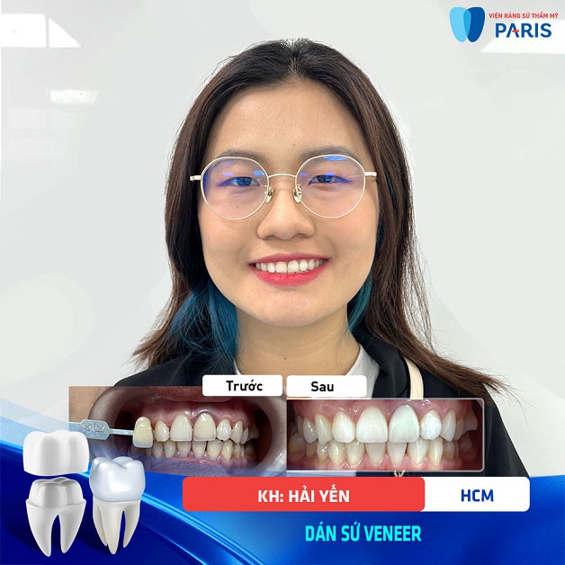 Răng sứ Veneer đảm bảo chính xác vẻ đẹp khách hàng mong muốn