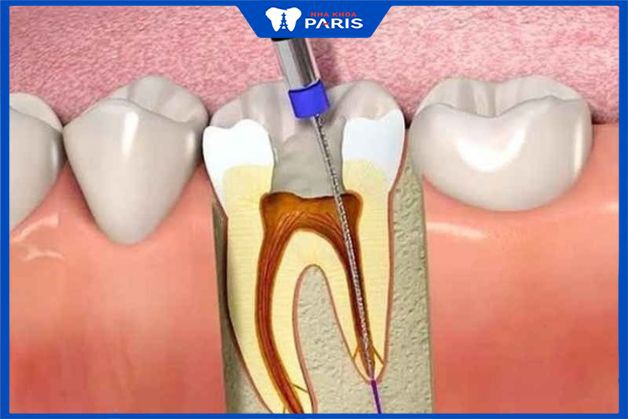 Lấy tủy răng không đau nhức khi ứng dụng công nghệ tân tiến