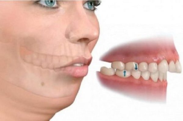 Nguyên nhân và giải pháp cho vấn đề bọc răng sứ bị hô