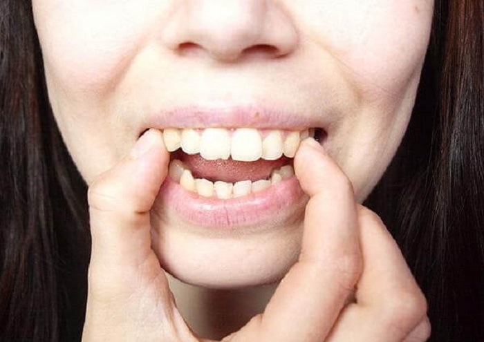 Bọc răng sứ bị hô có phổ biến không