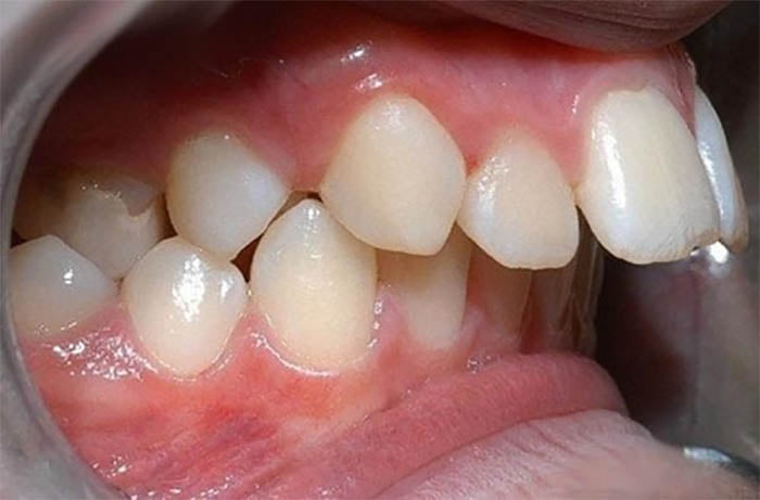 Những trường hợp nào nên bọc răng sứ