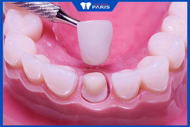 Bọc răng sứ thẫm mỹ an toàn và chất lượng phụ thuộc vào yếu tố nào