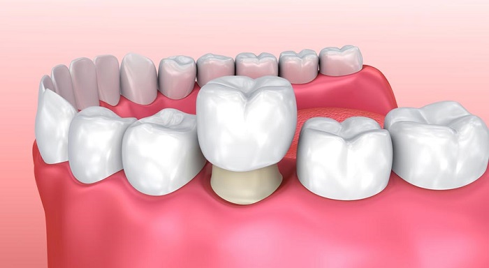 Bảo tồn tuổi thọ của răng thật
