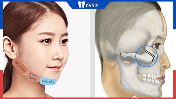 Phẫu thuật chỉnh hình xương mặt là gì và những lưu ý quan trọng