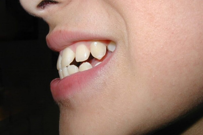 Phẫu thuật khắc phục tình trạng răng hô 
