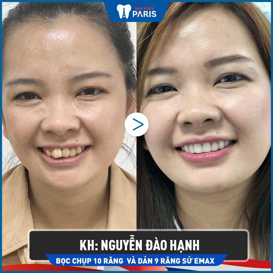 Khách hàng Nguyễn Bảo Hạnh dán răng sứ E.Max
