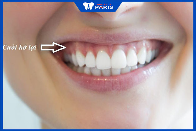 Nguyên nhân của nụ cười hở lợi do chân răng quá ngắn