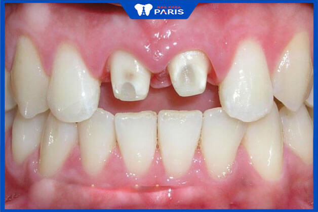 Biến chứng nguy hiểm khi bọc răng sứ thẫm mỹ ở nha khoa kém chất lượng