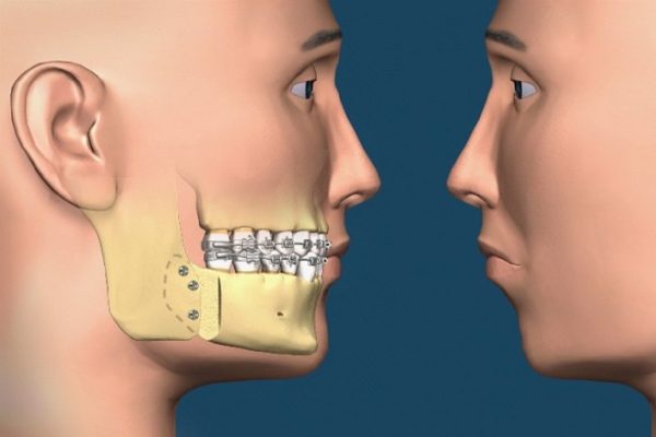 Phẫu thuật hàm hô không nhổ răng và những điều cần biết