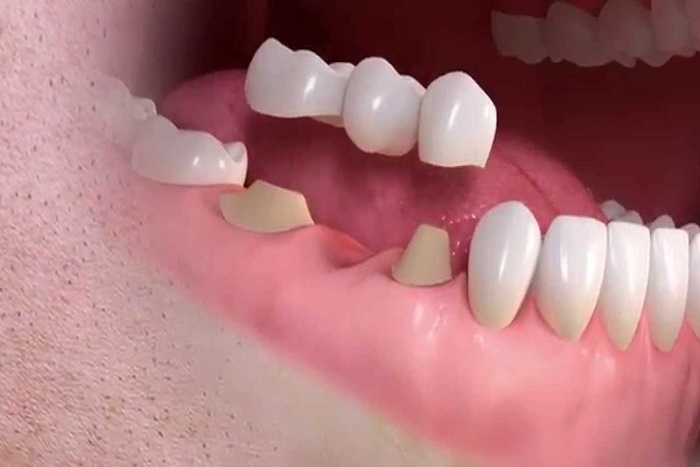 Răng trụ có thể phải được chỉnh sửa
