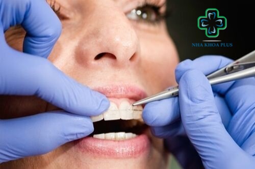 Quy trình niềng răng: bác sĩ gắn mắc cài lên răng