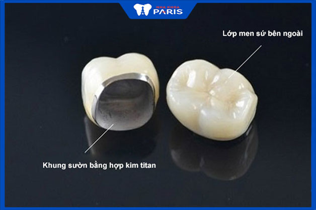 Răng sứ kim loại được hiểu là gì