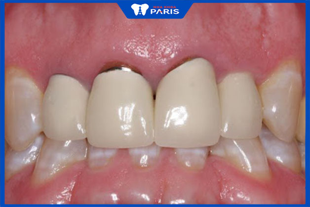 Loại răng sứ này thường có ưu điểm và hạn chế gì