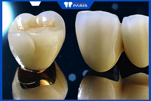 Tìm hiểu về răng sứ kim loại là gì