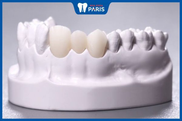 Tìm hiểu 7 Loại răng sứ không kim loại chất lượng cao