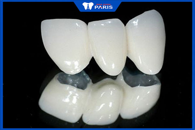 Ưu điểm và hạn chế của răng sứ kim loại thường