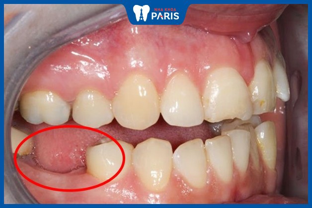 Khu vực răng mất là nơi khởi nguồn của nhiều bệnh lý