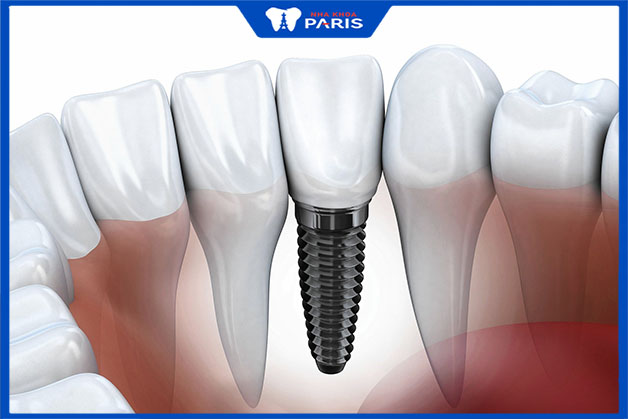 Cấy ghép implant đảm bảo chức năng cơ bản của răng