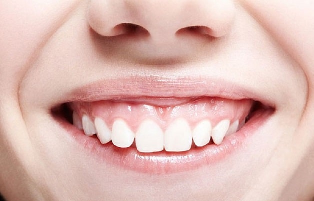 Cơ môi trên hoạt động quá nhiều cũng là nguyên nhân dẫn đến cười hở lợi