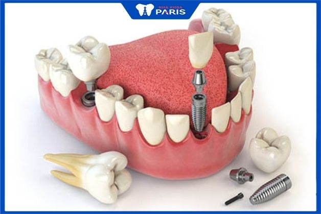 Đảm bảo sức khoẻ ổn định trước khi cấy răng