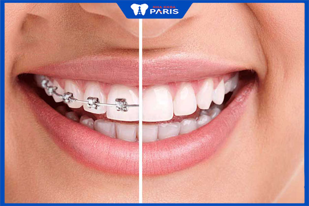 Hiệu quả của niềng răng mắc cài kim loại chịu ảnh hưởng từ độ tuổi thực hiện niềng