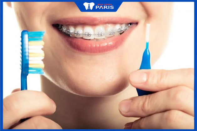 Chăm sóc răng trong quá trình niềng răng