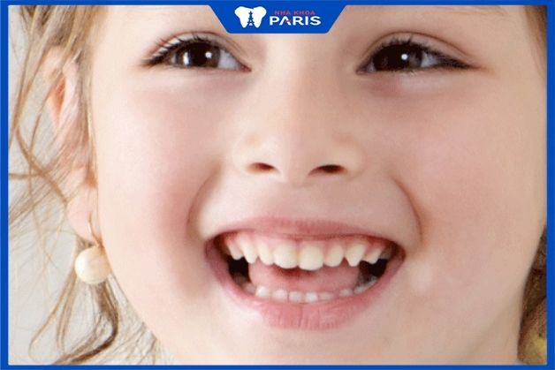 Niềng răng sớm cho trẻ mang lại nhiều lợi ích