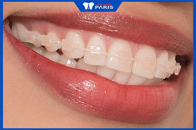 Niềng răng thẩm mỹ một hàm tại nha khoa Paris có tốt không?