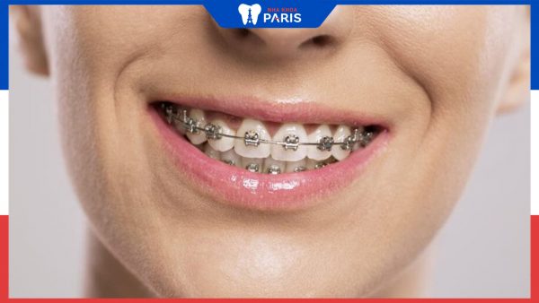 Giải đáp: Niềng răng mắc cài kim loại có đau không?